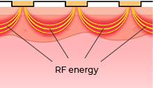 Non-invasive Potenza DIA tip Bipolar RF Energy