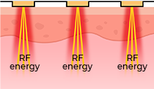 Diagram of non-invasive Potenza DIA tip delivering monopolar RF energy to the skin for Dia-lifting treatment.