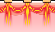 Diagram of Potenza DIA tip delivering monopolar/bipolar RF energy into the skin for a non-invasive procedure.