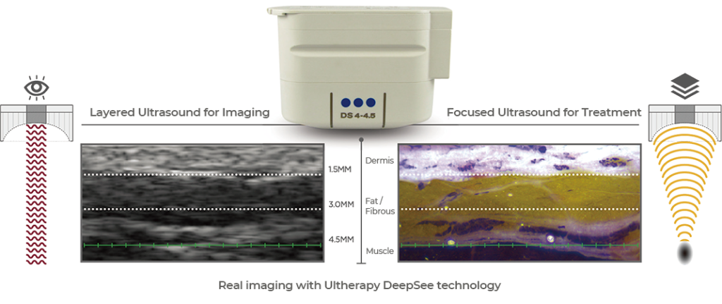 Real imaging with Ultherapy DeepSee Technology for imaging and treatment